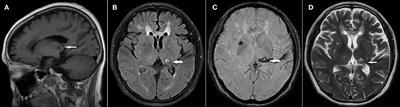 Case report: Cheek acupuncture exhibits an immediate effect in relieving severe pain associated with nerve compression or damage of central nervous system and its potential mechanism of action